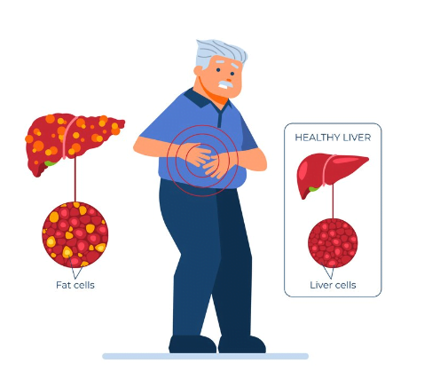 Fatty Liver Ayurvedic Medicine